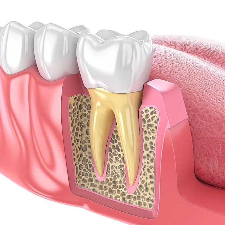 Dental Extraction
